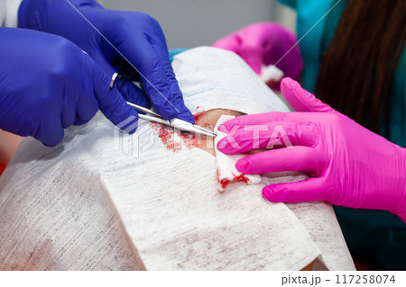 Doctor suturing a patient during a small surgery. Dermatologist carrying out a removal of benign skin lesion on the face of a young male patient. 117258074
