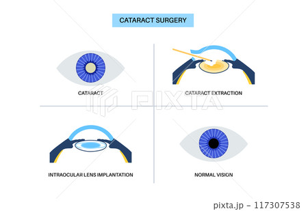 Cataract surgery poster 117307538