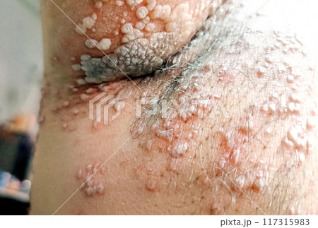 A Close up view of women with shingles (herpes zoster) disease on skin and he feel very painful 117315983