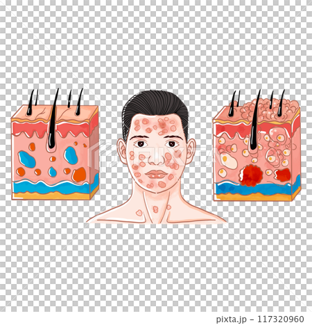 Severe Acne Causes and Treatment 117320960