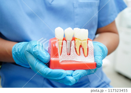 Doctor hold dental implant, artificial tooth roots into jaw, root canal of dental treatment, gum disease, teeth model for dentist studying about dentistry. 117323455
