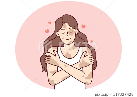 Positive girl with vitiligo disease hugging herself taking skin diseases as personal feature 117327429