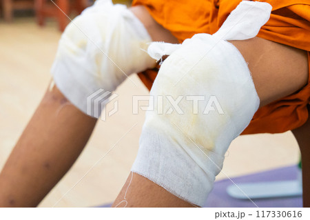 Knee pain relief with herbal. Knee osteoarthritis. Thai traditional medicine Knee pain relief with herbal. Knee osteoarthritis. Thai traditional medicine 117330616