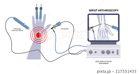 Wrist arthroscopy surgery 117331435