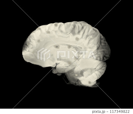 Sagittal View of Brain Showing MS-Related Albumin Leakage Sagittal View of Brain Showing MS-Related Albumin Leakage 117349822