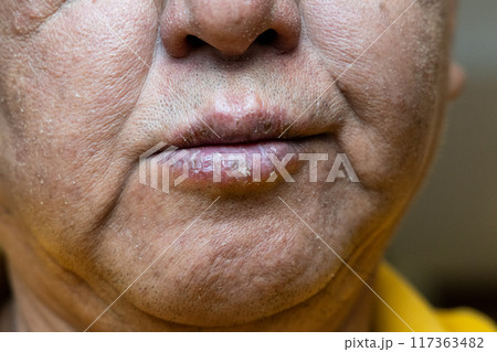 Closeup of elderly Asian man with dry face and chapped cracked lips with dryness during winter Closeup of elderly Asian man with dry face and chapped cracked lips with dryness during winter 117363482