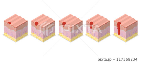 3D Isometric Flat  Illustration of Melanoma Cancer, Dermatology and Skin Health 117368234