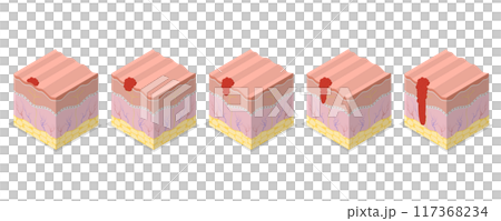 3D Isometric Flat  Illustration of Melanoma Cancer, Dermatology and Skin Health 117368234