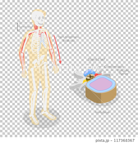 3D Isometric Flat  Illustration of Cervical Radiulopathy, Traumatic Spinal Cord Injury with Painful Pinched Nerves 117368367