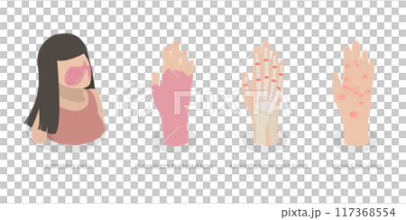 3D Isometric Flat  Illustration of Systemic Lupus Erythematosus, Butterfly Rash Red Patches 117368554
