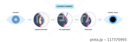 Cataract surgery poster Cataract surgery poster 117370993