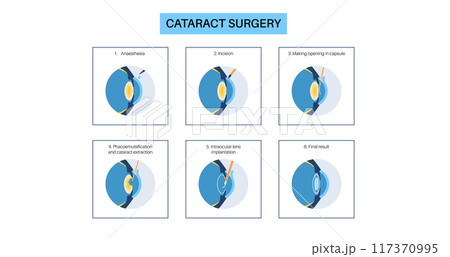 Cataract surgery poster Cataract surgery poster 117370995
