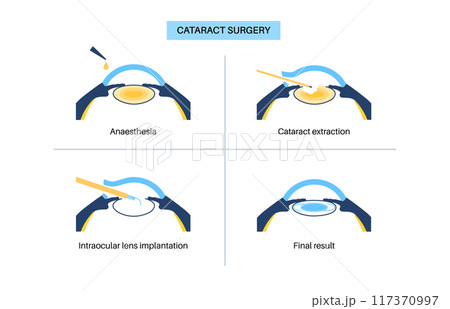 Cataract surgery poster 117370997