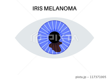 Iris melanoma anatomy 117371005