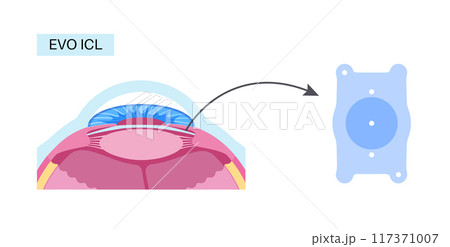 EVO ICL poster 117371007