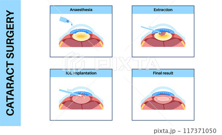 Cataract surgery poster 117371050