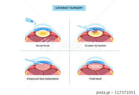 Cataract surgery poster Cataract surgery poster 117371051