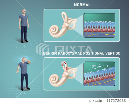 Benign paroxysmal positional vertigo 117372088