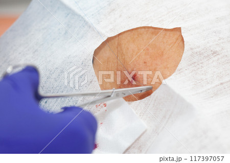 Doctor suturing a patient during a small surgery. Dermatologist carrying out a skin biopsy on the face of a senior adult patient. Doctor suturing a patient during a small surgery. Dermatologist carrying out a skin biopsy on the face of a senior adult patient. 117397057