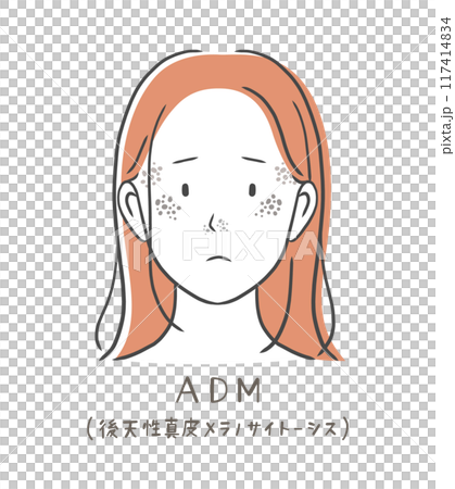 Illustration material of a woman suffering from age spots (ADM) 117414834
