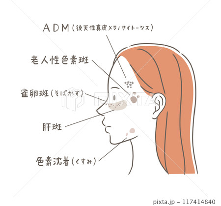 シミの種類と横顔の女性のイラスト素材 117414840
