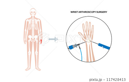 Wrist arthroscopy surgery 117428413