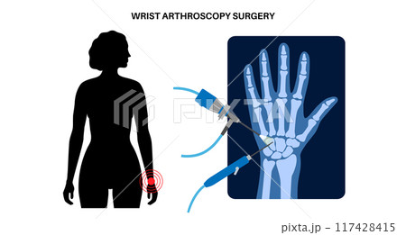 Wrist arthroscopy surgery 117428415