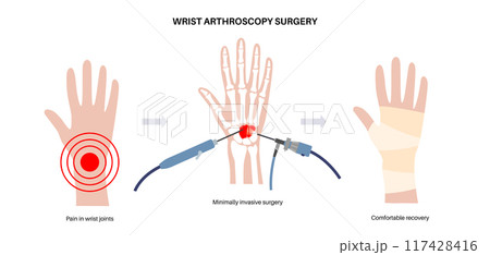 Wrist arthroscopy surgery 117428416