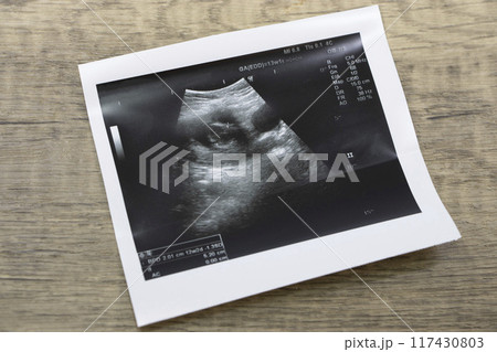 妊娠 エコー写真 妊娠検査薬 117430803