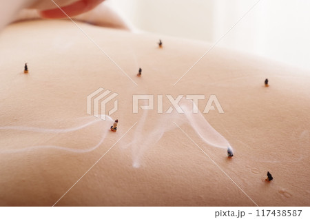 鍼灸院で背中に鍼灸治療をする女性 鍼灸院で背中に鍼灸治療をする女性 117438587