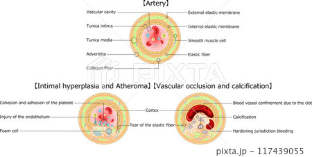 血管　閉塞　アテローム　イラスト　英語 117439055