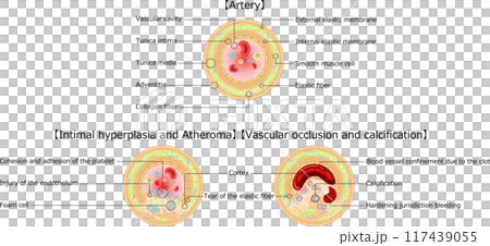 血管　閉塞　アテローム　イラスト　英語 117439055