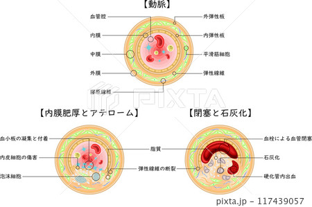 血管　閉塞　アテローム　イラスト　日本語 117439057