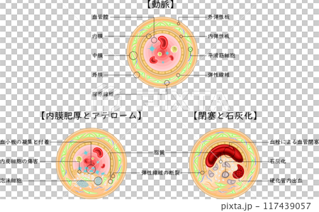 血管閉塞粥樣斑塊插圖日語 血管閉塞粥樣斑塊插圖日語 117439057