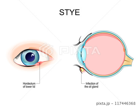 Stye. Hordeolum. Cross section of a humans eyeball with Infection Stye. Hordeolum. Cross section of a humans eyeball with Infection 117446368