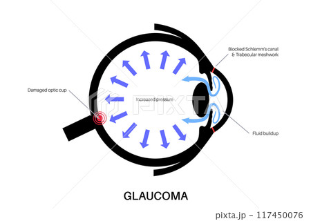 Glaucoma eye pressure Glaucoma eye pressure 117450076