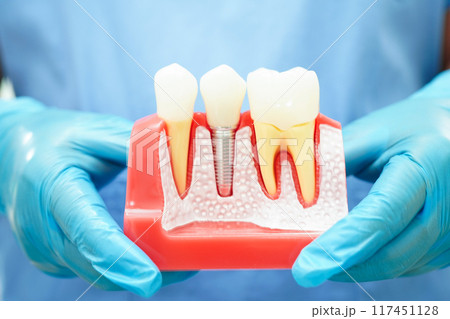 Doctor hold dental implant, artificial tooth roots into jaw, root canal of dental treatment, gum disease, teeth model for dentist studying about dentistry. 117451128