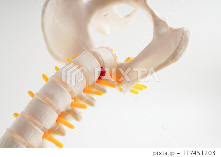 Spinal nerve and bone, Lumbar spine displaced herniated disc fragment, Model for treatment medical in the orthopedic department. 117451203