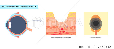 Macular degeneration poster 117454342