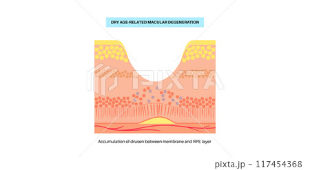 Macular degeneration poster 117454368
