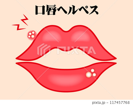 口唇ヘルペスのイラスト素材 口唇ヘルペスのイラスト素材 117457768