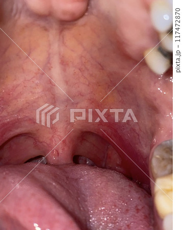 Close up view of human jaw showing teeth and braces on dental treatment 117472870