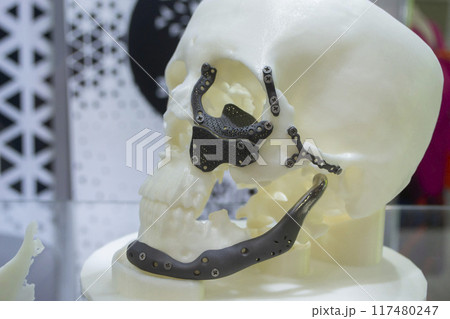 Prototype of human skull from white plastic with titanium implants in form of plates and surgical templates printed on 3D printer. Biointegrated prosthesis. Medicine medical Prototype of human skull from white plastic with titanium implants in form of plates and surgical templates printed on 3D printer. Biointegrated prosthesis. Medicine medical 117480247