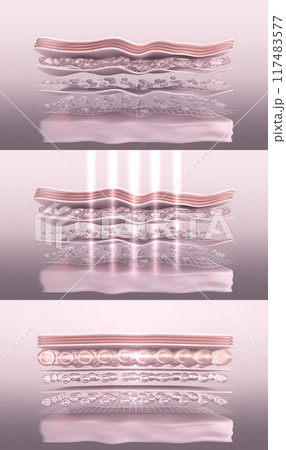 Skin before and after laser collagen-boosting therapy. Stylized wrinkled and tightened skin layer 3D render Skin before and after laser collagen-boosting therapy. Stylized wrinkled and tightened skin layer 3D render 117483577