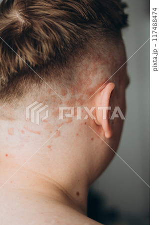 Psoriasis on the skin close-up, scalp, photos of dermatitis and eczema, skin problems concept, dermatology banner 117488474