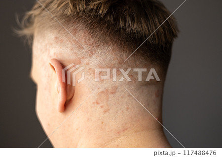 Psoriasis on the skin close-up, scalp, photos of dermatitis and eczema, skin problems concept, dermatology banner Psoriasis on the skin close-up, scalp, photos of dermatitis and eczema, skin problems concept, dermatology banner 117488476