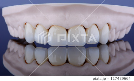 High-quality six dental crowns made of zirconium for fixation to the frontal teeth of upper jaw. High-quality six dental crowns made of zirconium for fixation to the frontal teeth of upper jaw. 117489664