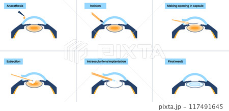 Cataract surgery poster Cataract surgery poster 117491645