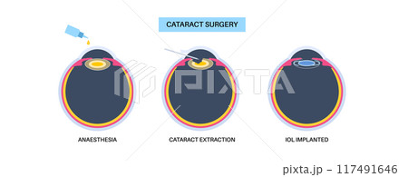 Cataract surgery poster Cataract surgery poster 117491646