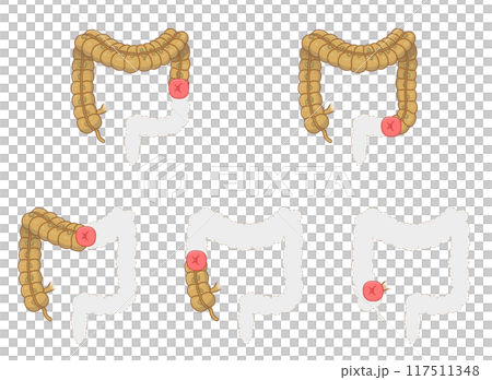 人工肛門、ストーマ、大腸、イラスト、illustration 117511348